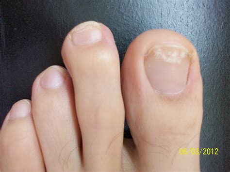 How Does Nail Fungus Look