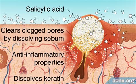 What Causes Acne Salicylic Acid