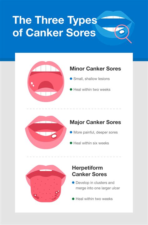 What Causes Herpetiform Canker Sores