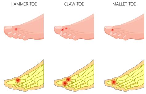 What Causes Toe Cramps And Curling